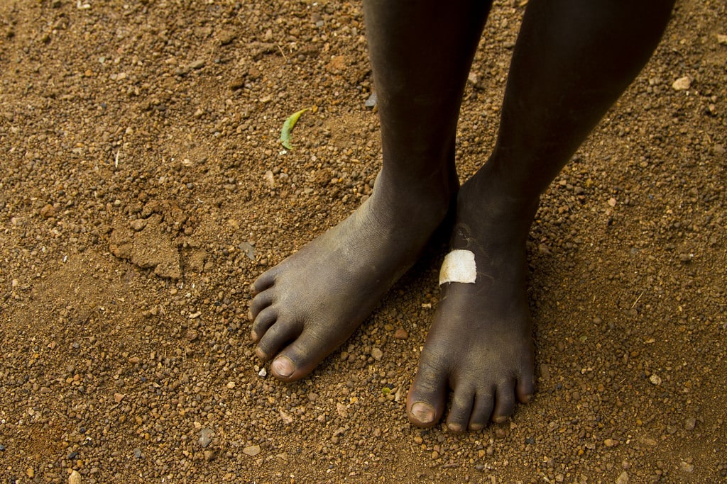 Im Fokus: Drakunkulose – Der Niedergang des Guinea-Wurms